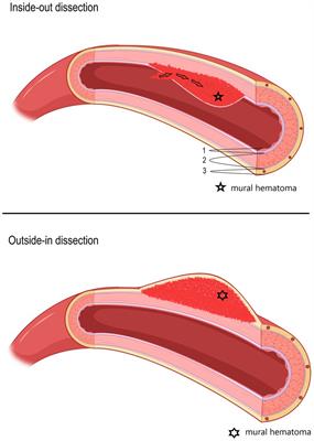 A narrative review on cervical artery dissection-related cranial nerve palsies